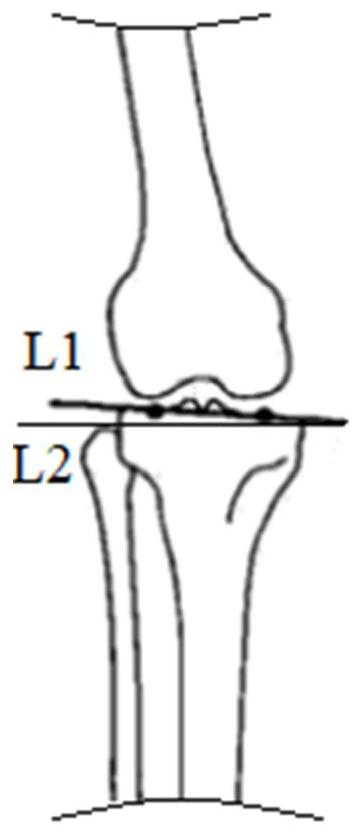 Matching method of tibial prosthesis and tibia and treater