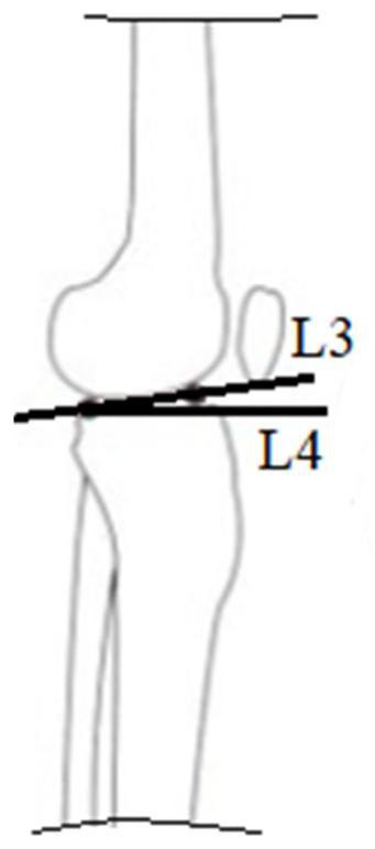 Matching method of tibial prosthesis and tibia and treater