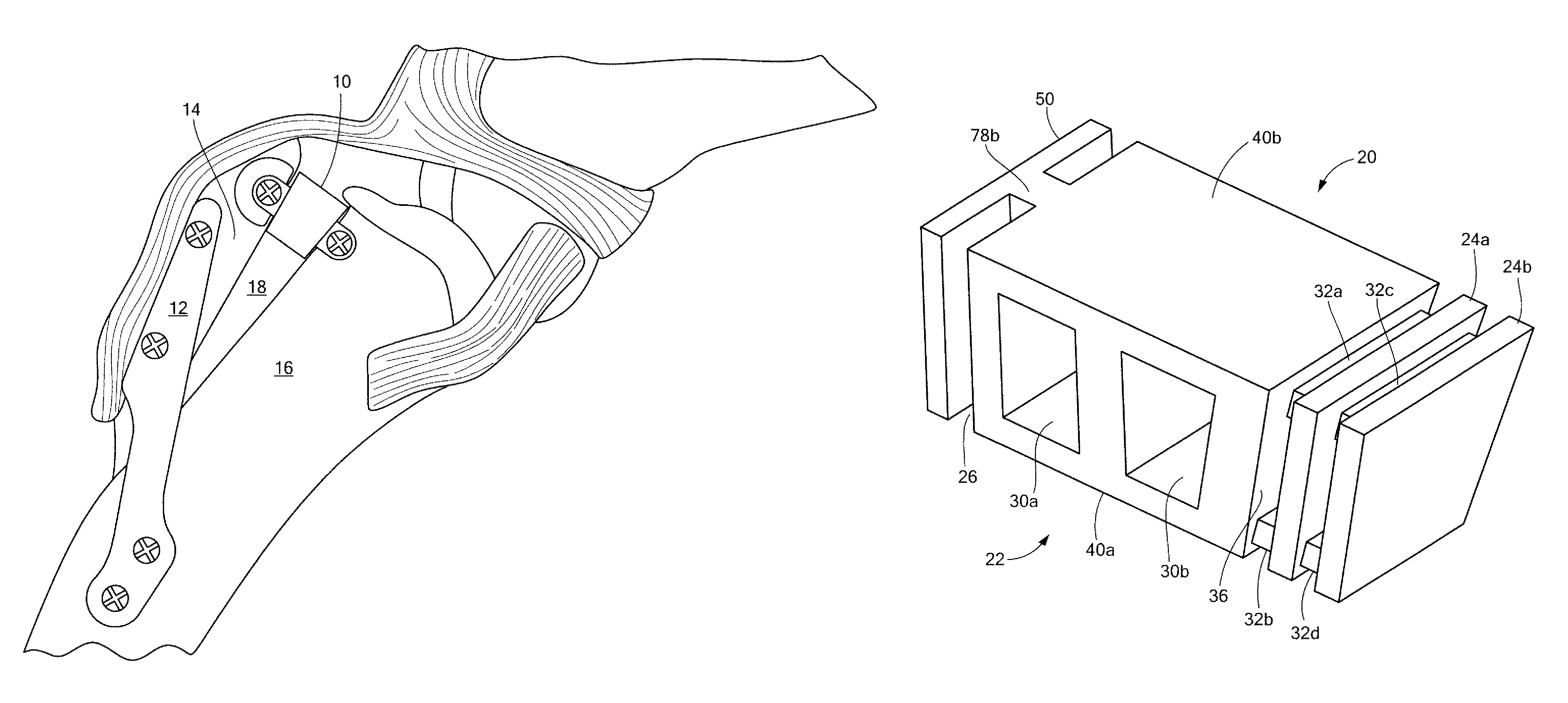 Tibial tuberosity advancement implant