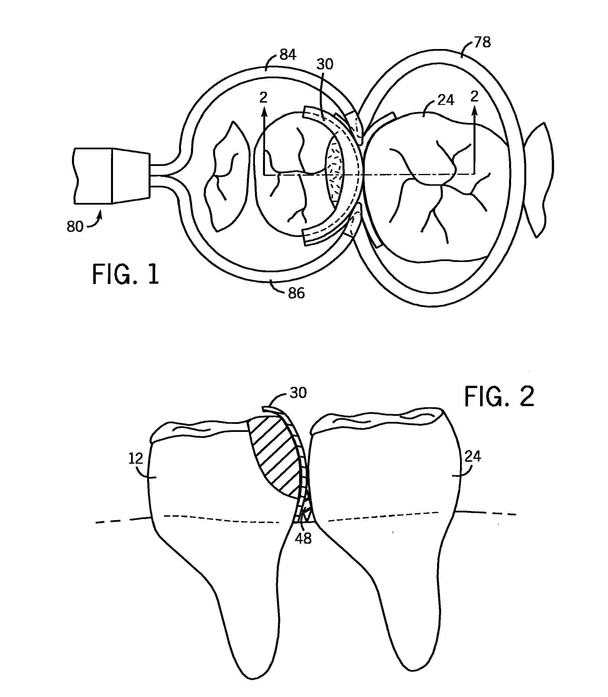 Dental Separator Rings And A Seamless, Single Load Cavity Preparation And Filling Technique