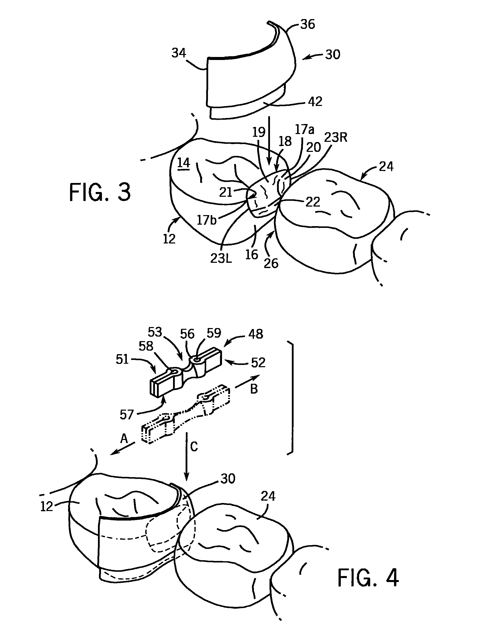 Dental Separator Rings And A Seamless, Single Load Cavity Preparation And Filling Technique