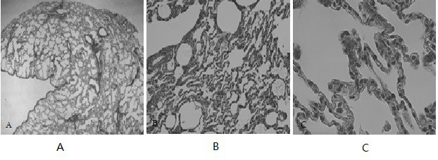 Pulmonary fibrosis cynomolgus monkey model induced by bleomycin and application of cynomolgus monkey model