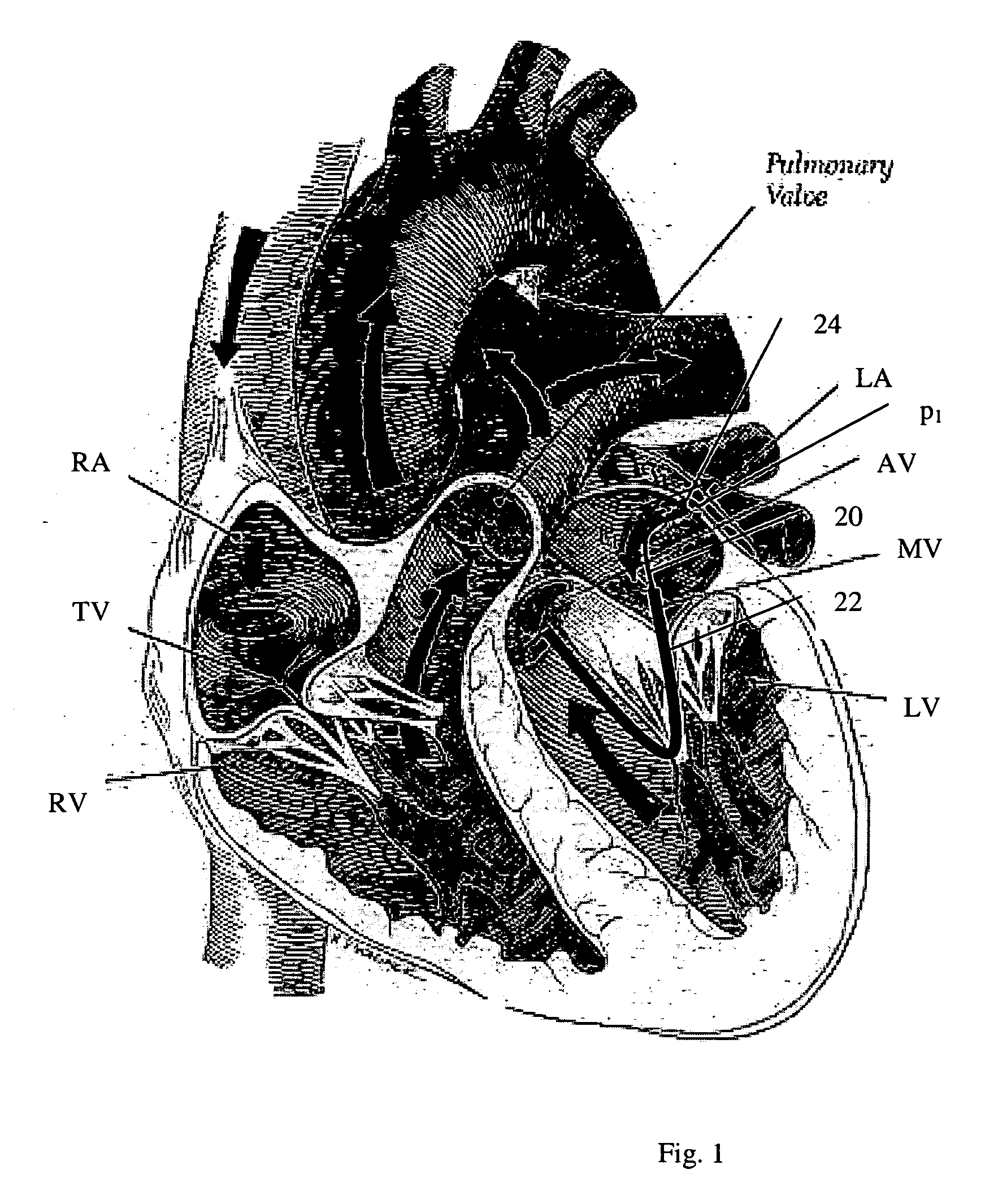 Navigation of remotely actuable medical device using control variable and length