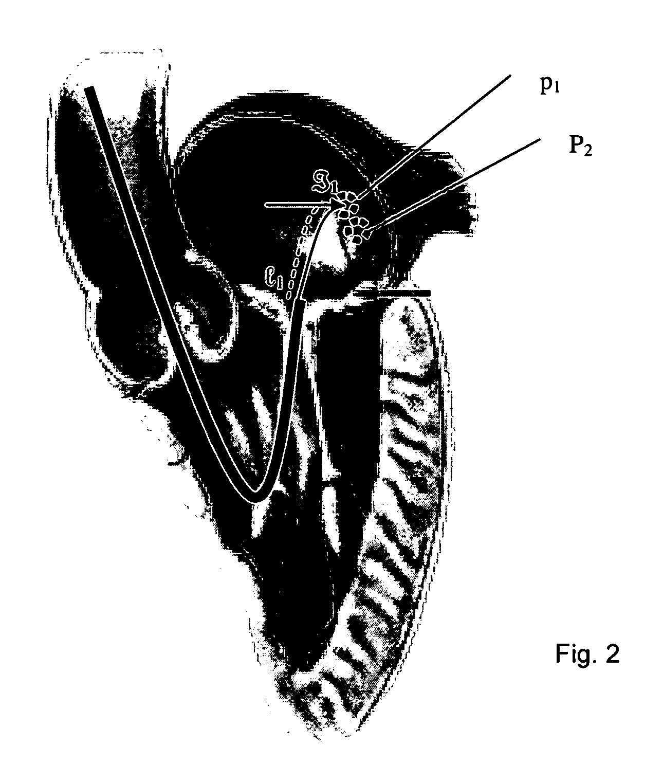 Navigation of remotely actuable medical device using control variable and length