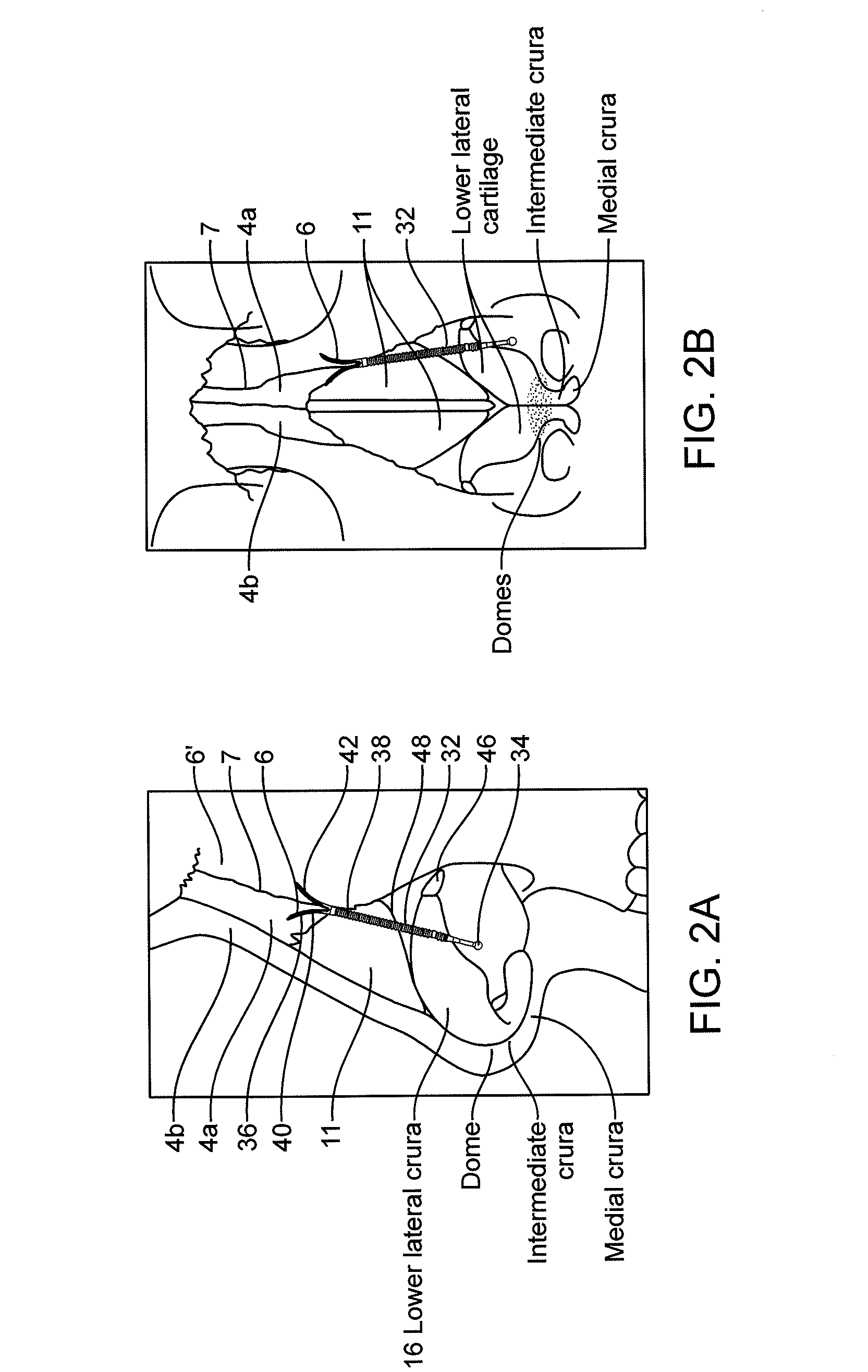 Nasal implants and systems and method of use