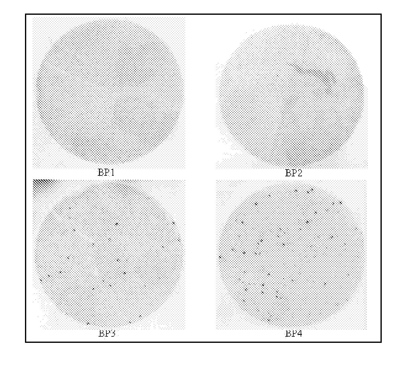 Neoepitope detection of disease using protein arrays