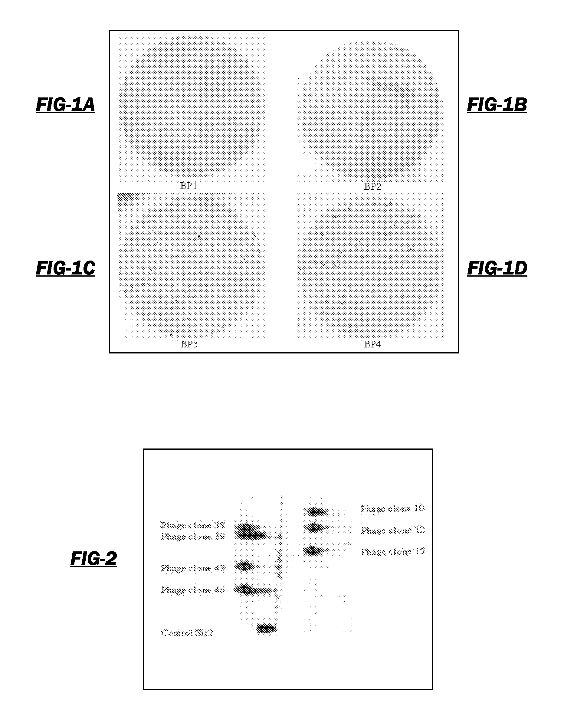 Neoepitope detection of disease using protein arrays