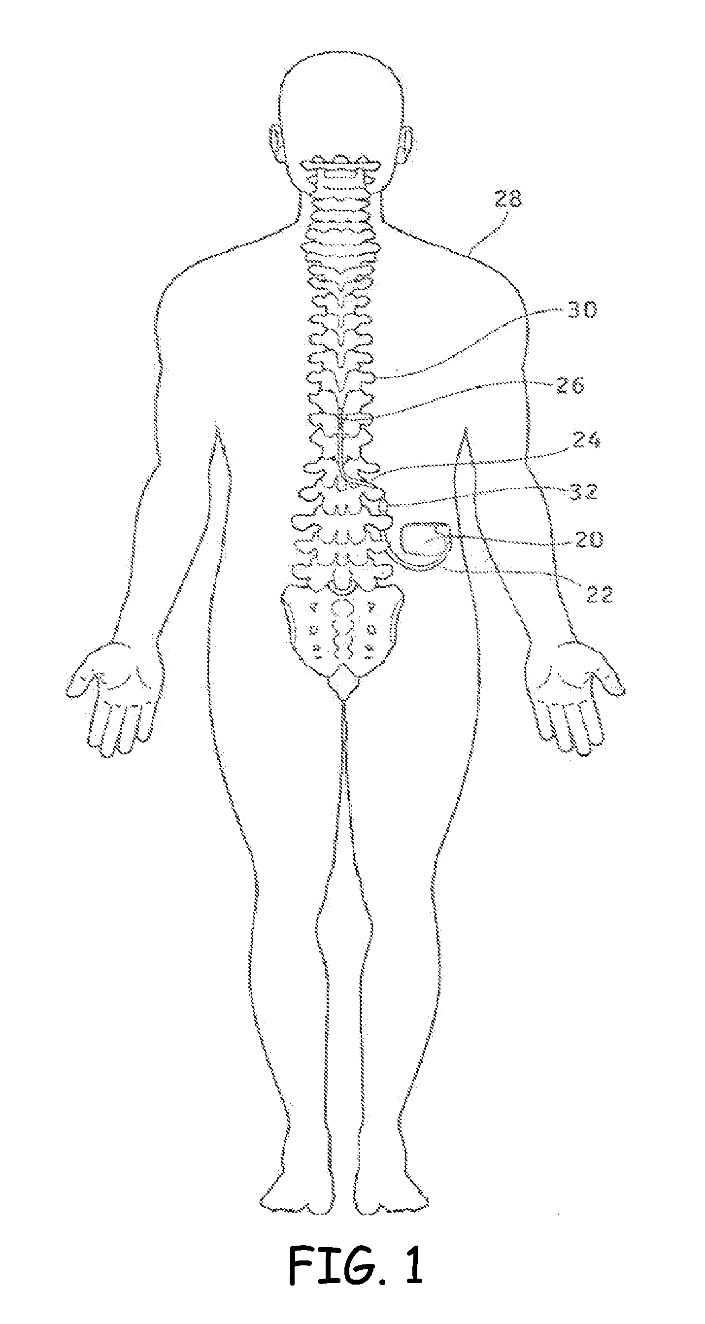 Diffusion bonded lead connector