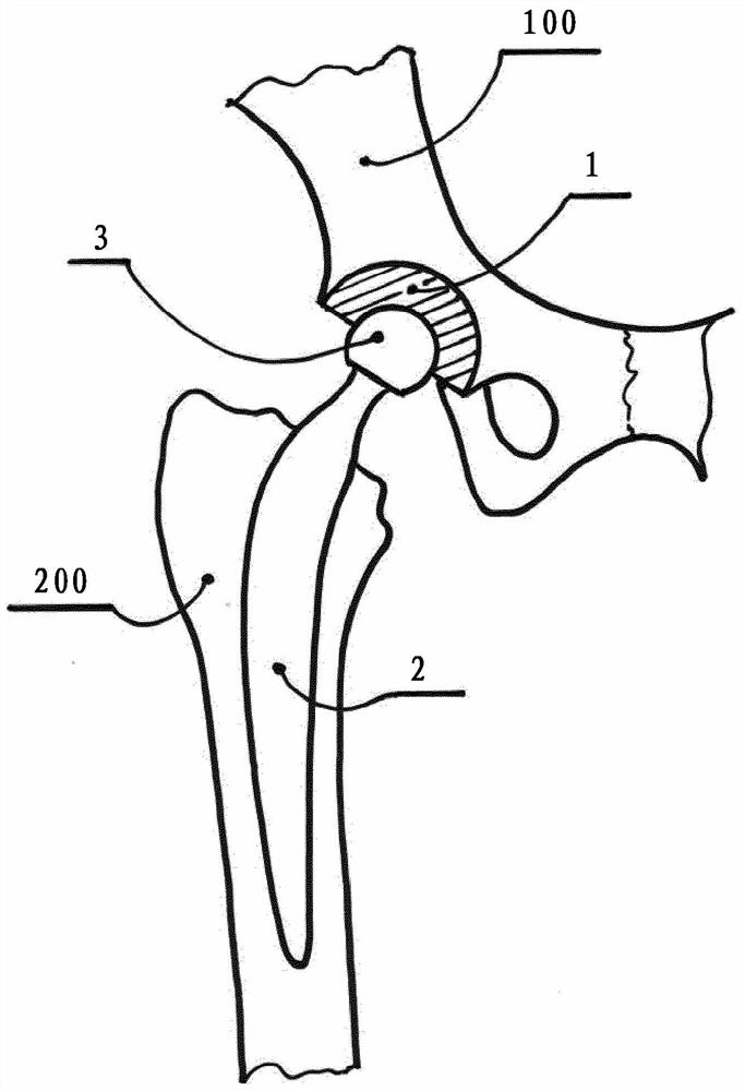 Resurfacing cup for acetabulum hemiarthroplasty of hip joint