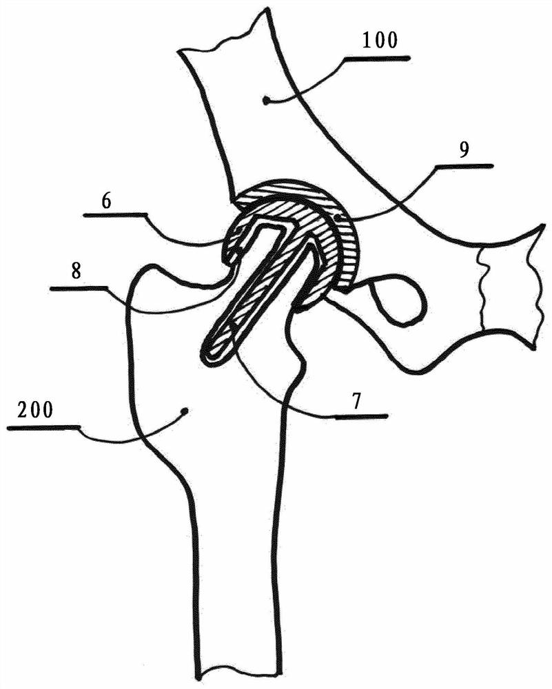 Resurfacing cup for acetabulum hemiarthroplasty of hip joint