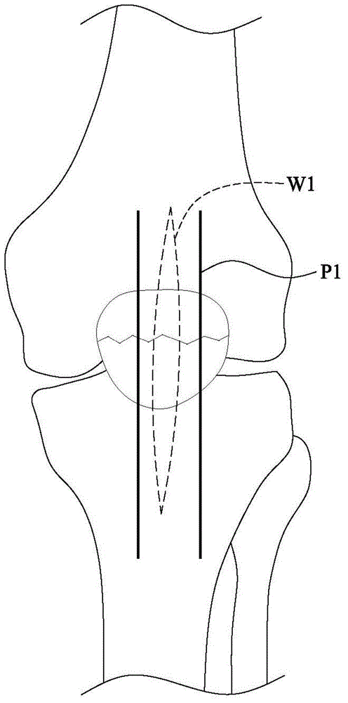 Skeleton fixing device