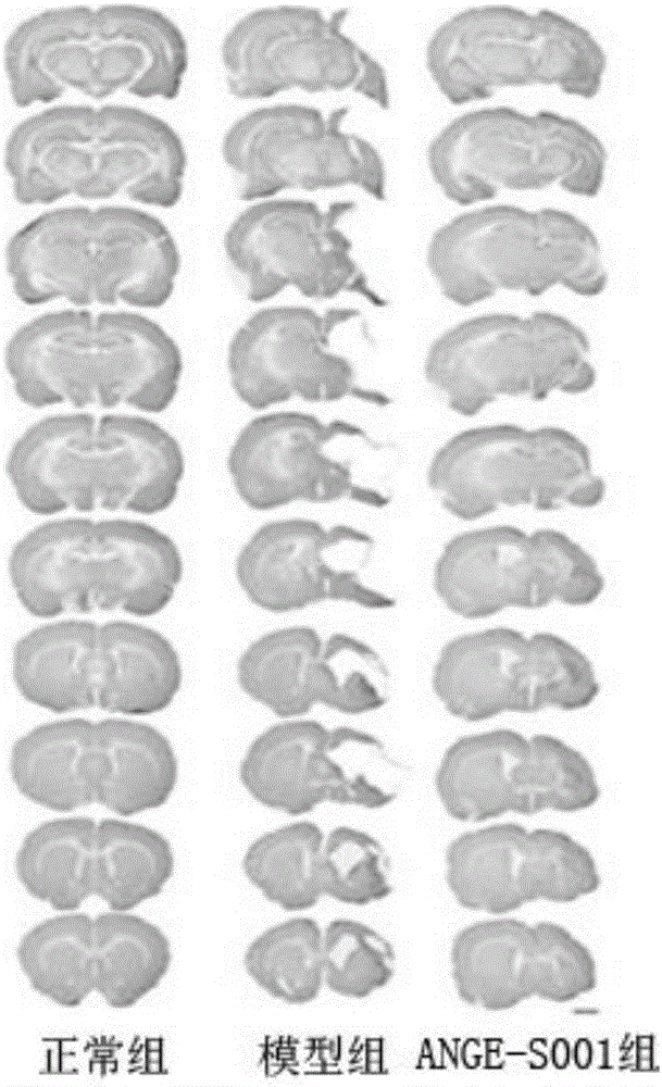 Neural stem cell injection for treating brain damage disease