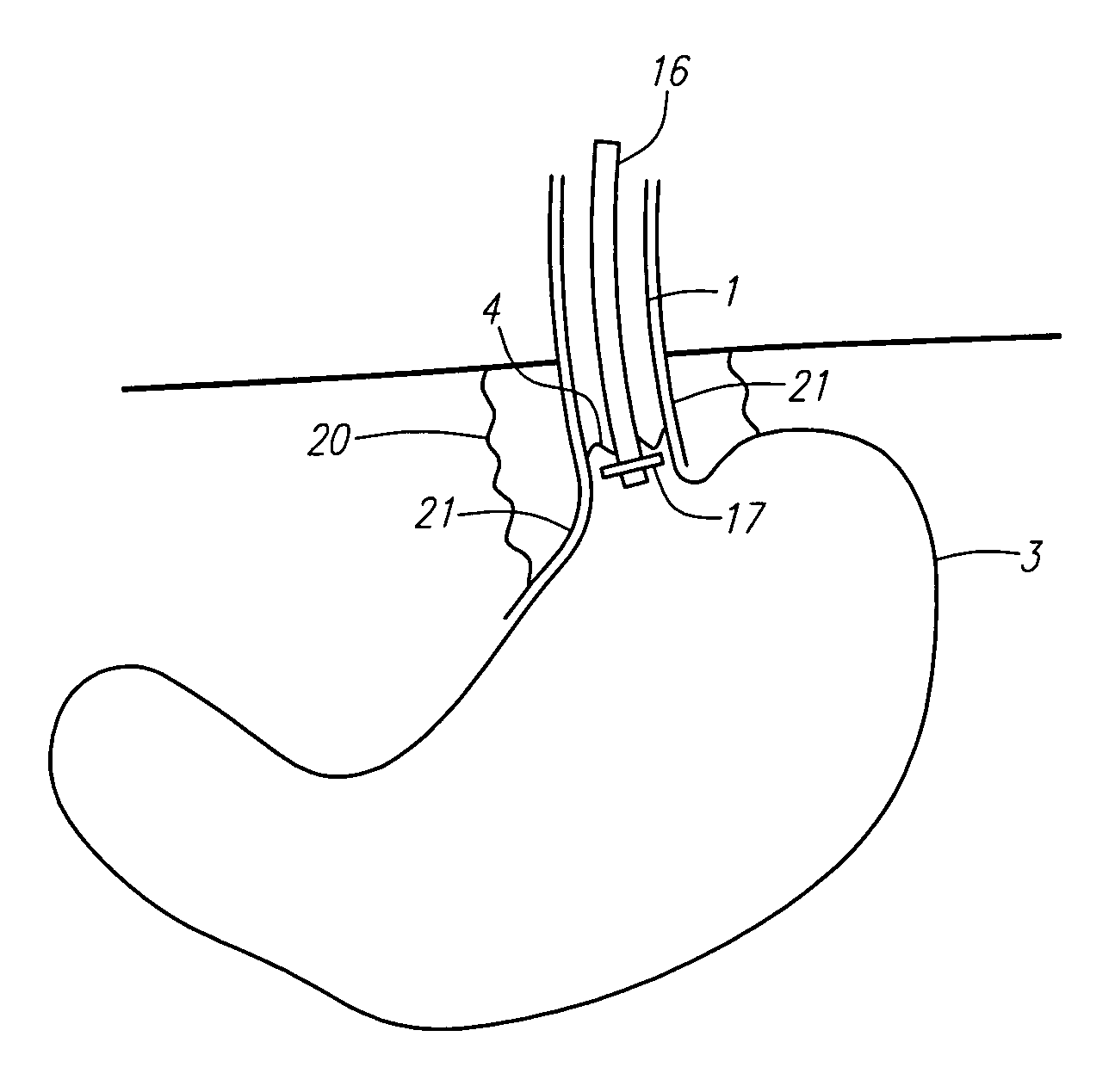 Methods and apparatus for treatment of obesity with an ultrasound device movable in two or three axes