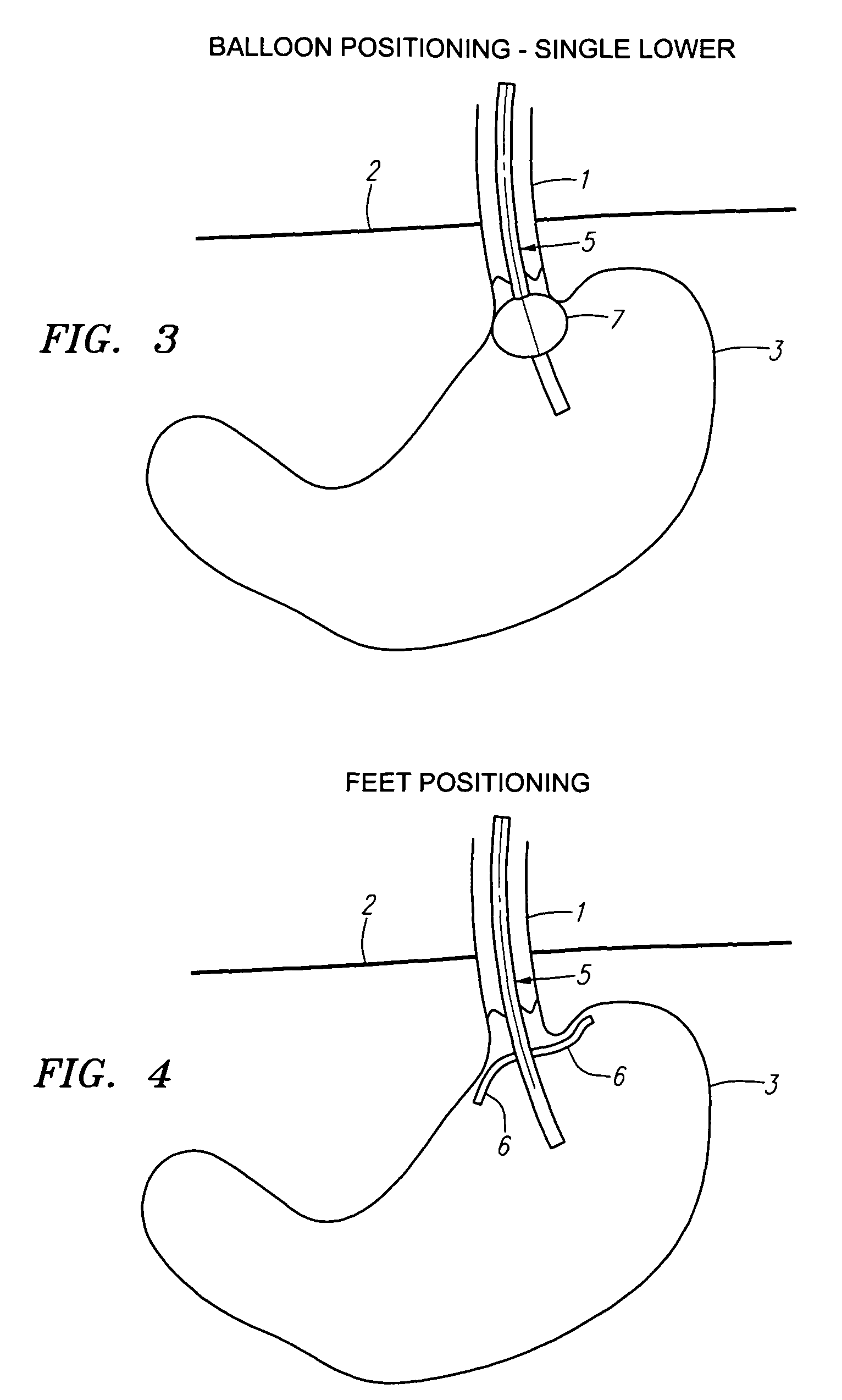 Methods and apparatus for treatment of obesity with an ultrasound device movable in two or three axes