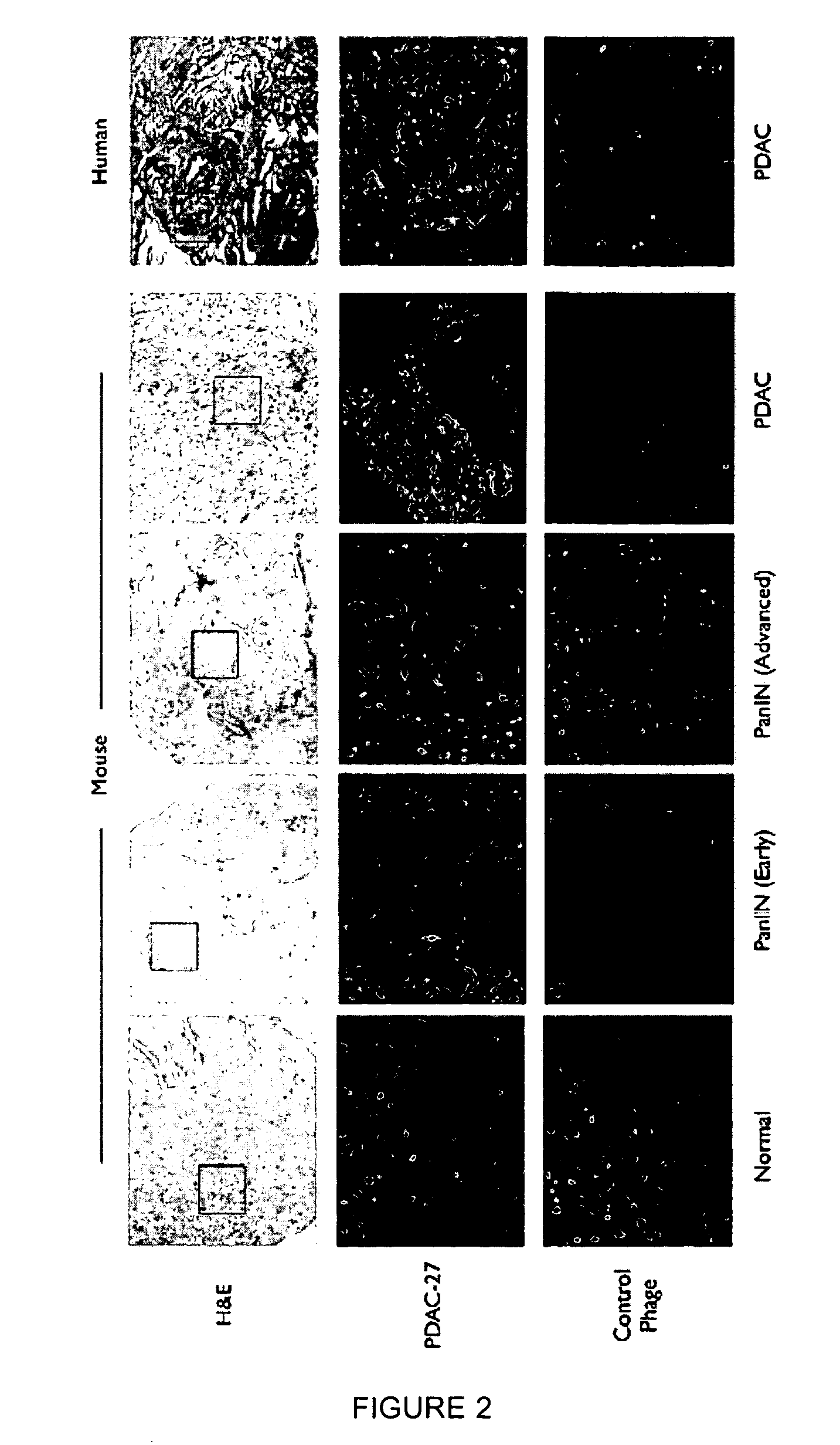 Plectin-1 targeted agents for detection and treatment of pancreatic ductal adenocarcinoma