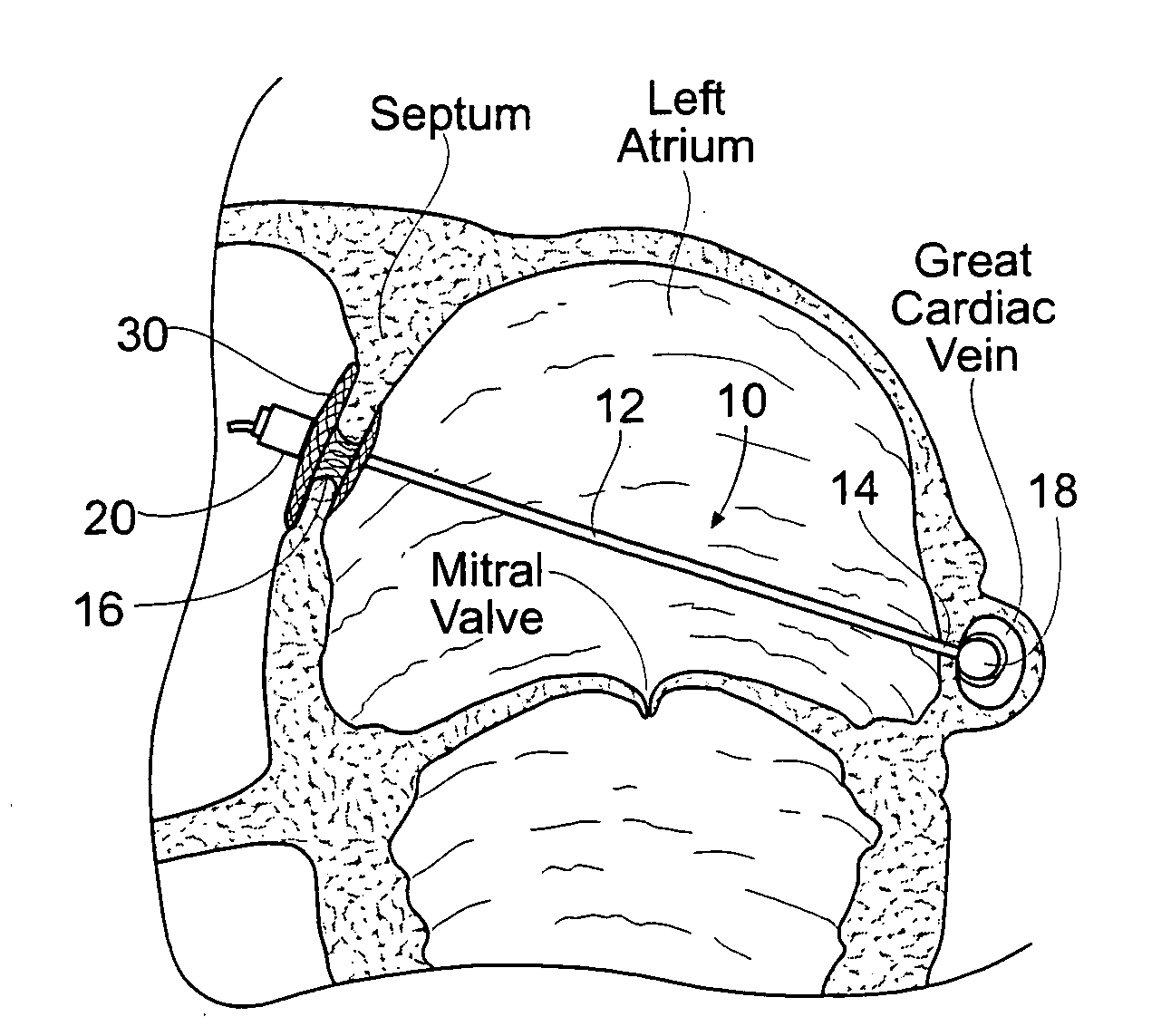 Devices, systems, and methods for reshaping a heart valve annulus