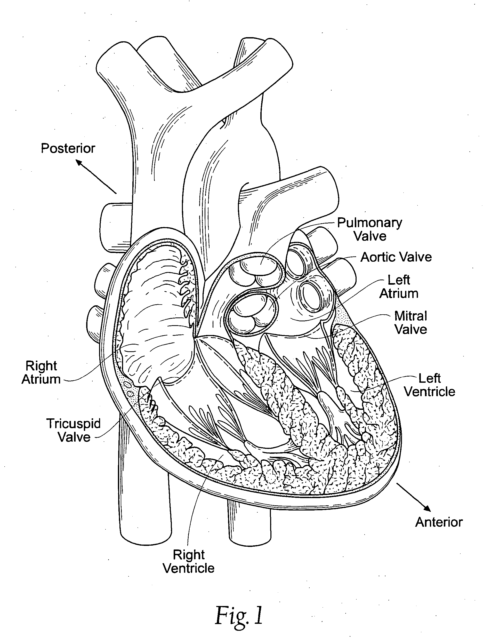 Devices, systems, and methods for reshaping a heart valve annulus