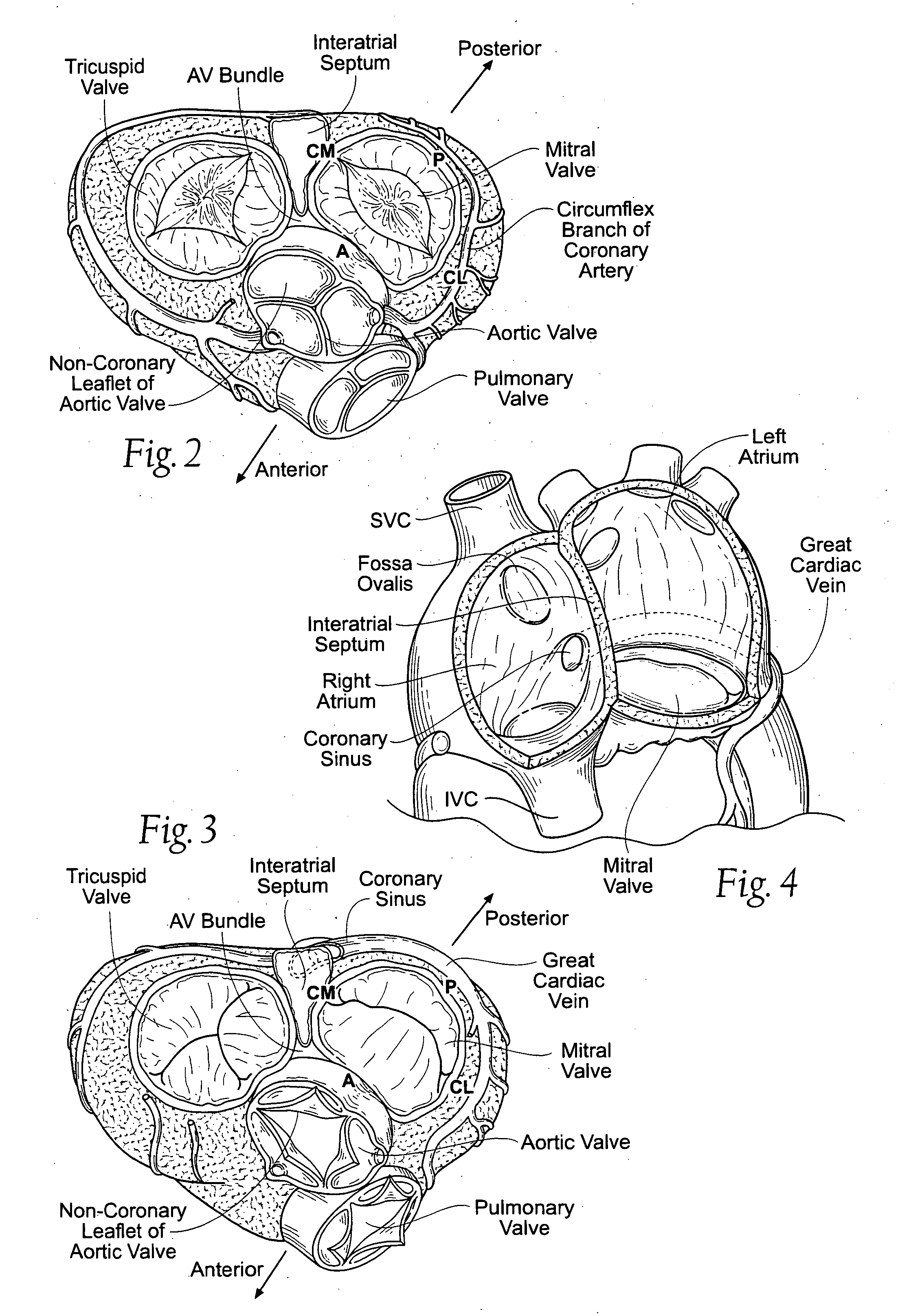 Devices, systems, and methods for reshaping a heart valve annulus