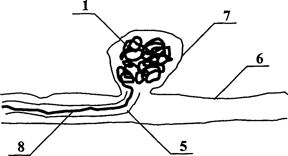 Removable spring ring for treating angioma