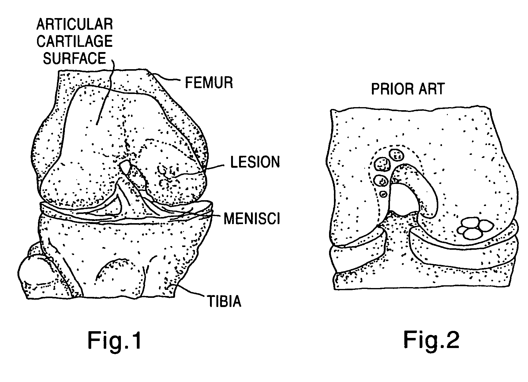 Two piece cancellous construct for cartilage repair