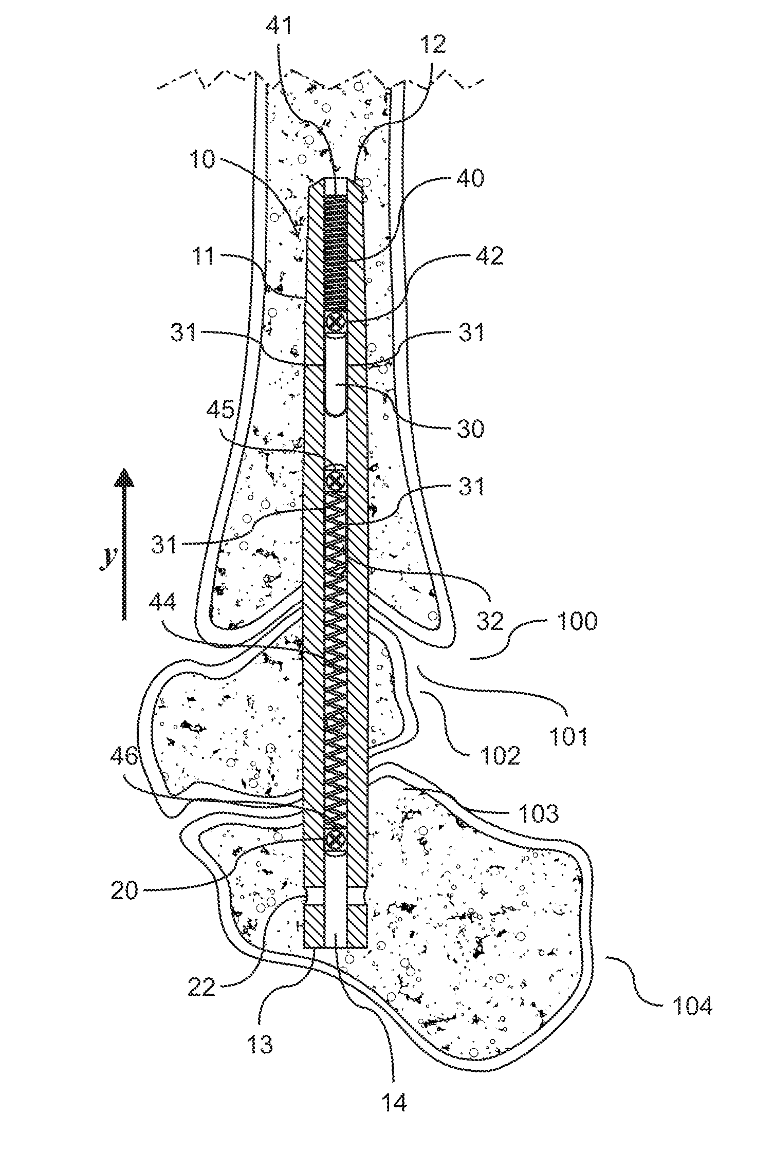 Intramedullary nail, system, and method with dynamic compression