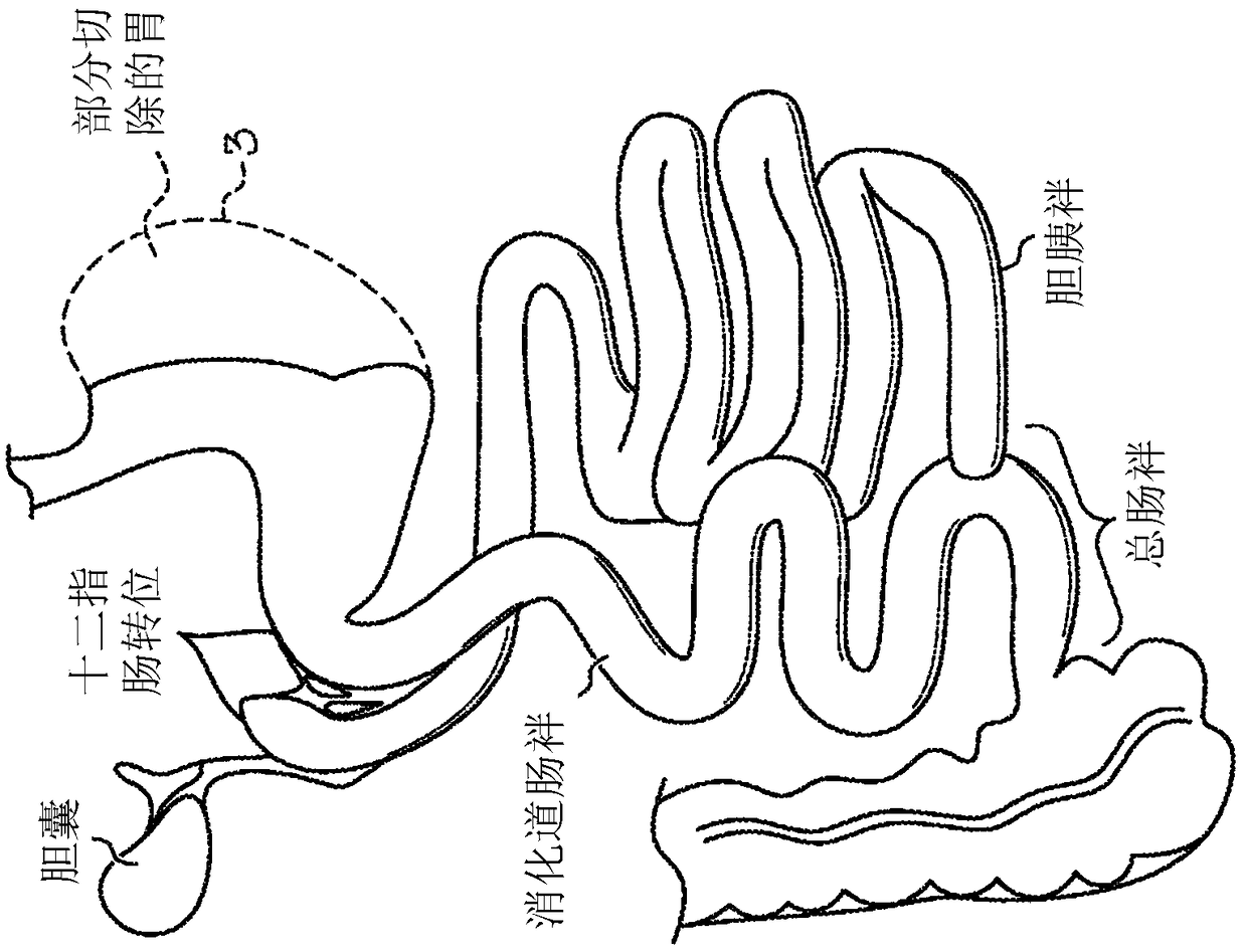 Device for bariatric stent allowing normal function of pyloric sphincter