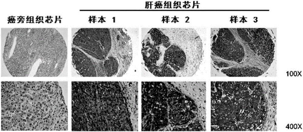 Application of CHKA proteins in preparing kit for prognostic evaluation of liver cancer, kit and method