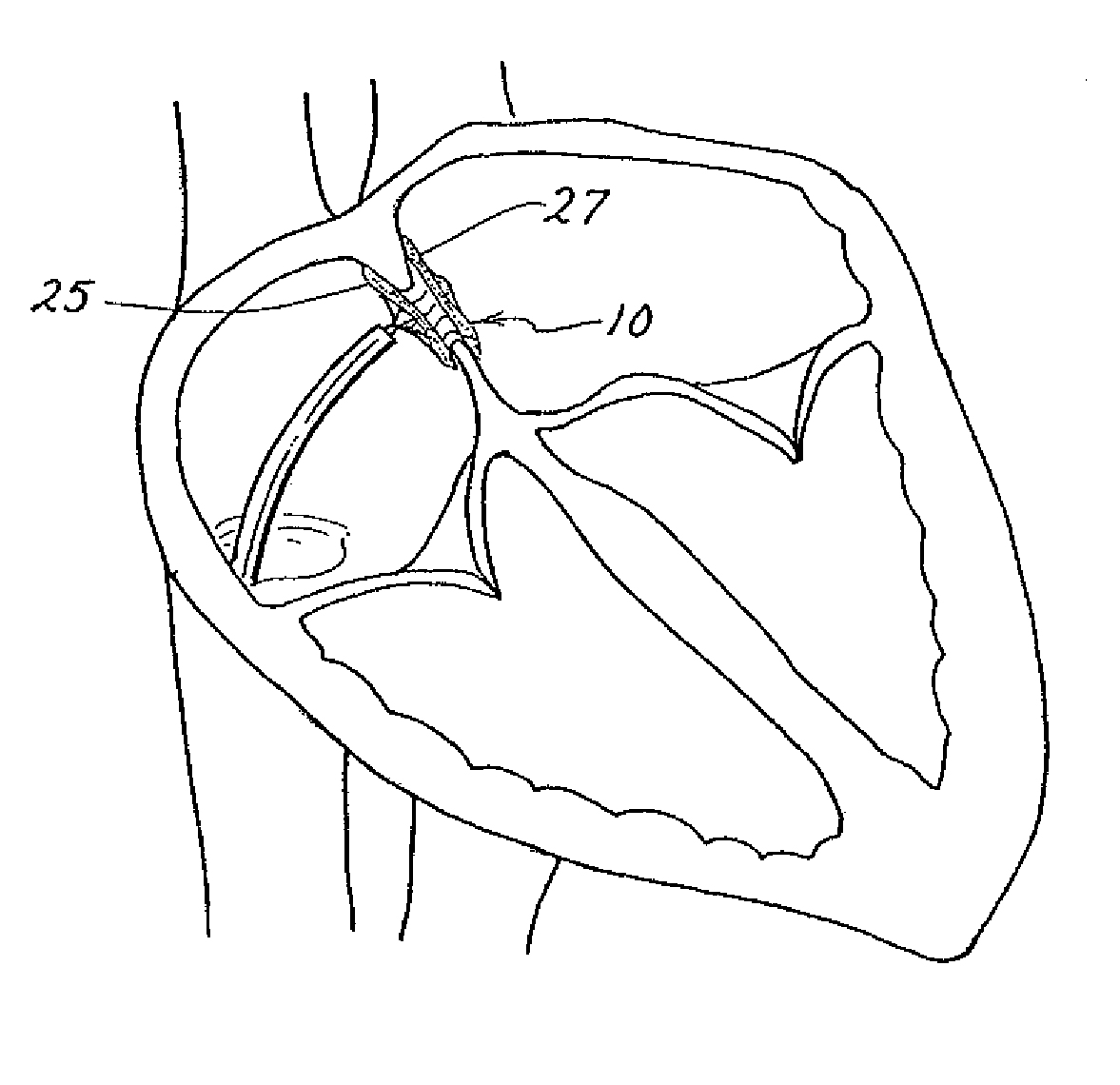 Medical device for occluding a heart defect and a method of manufacturing the same