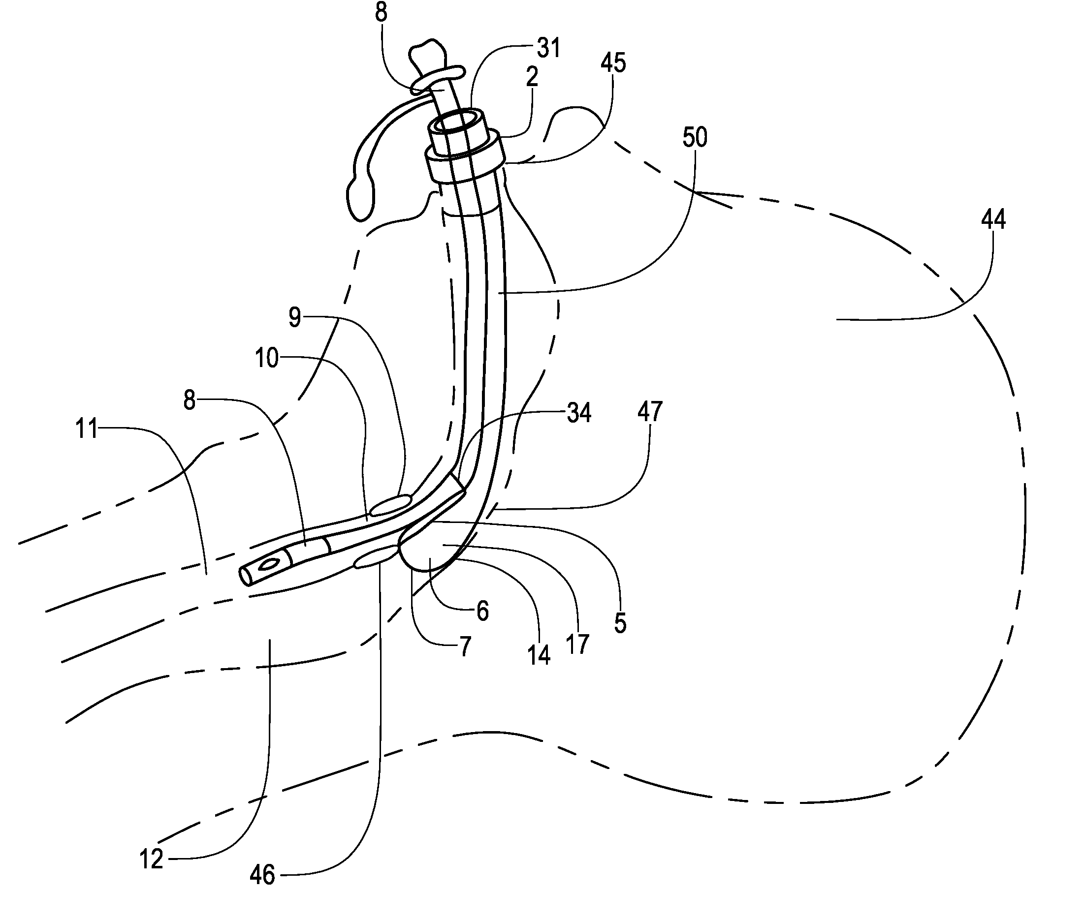 Airway devices and methods of making and using the same