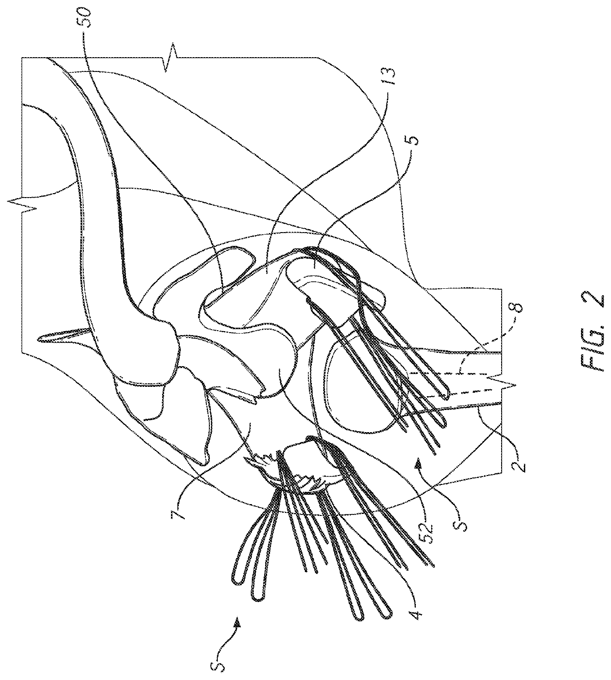 Patient-specific bone fracture prostheses and methods of making the same