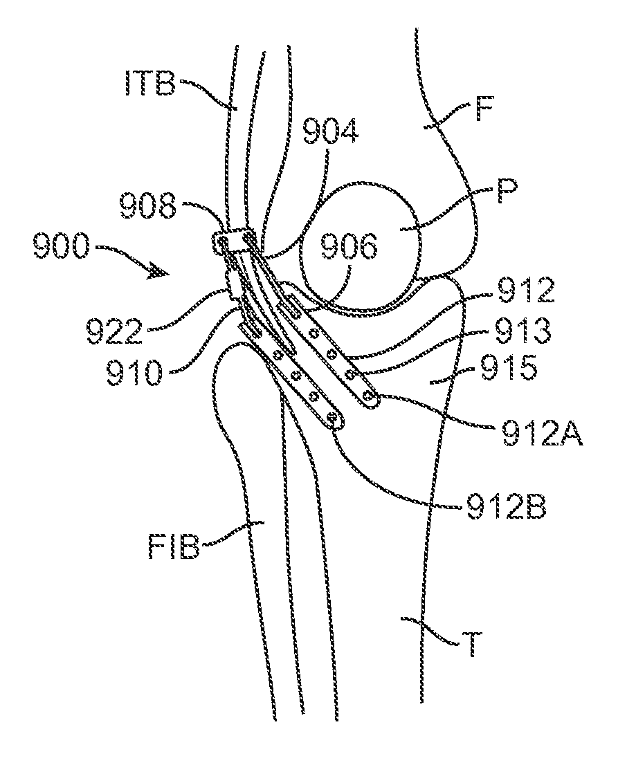 Method and Apparatus for Altering Biomechanics of the Articular Joints