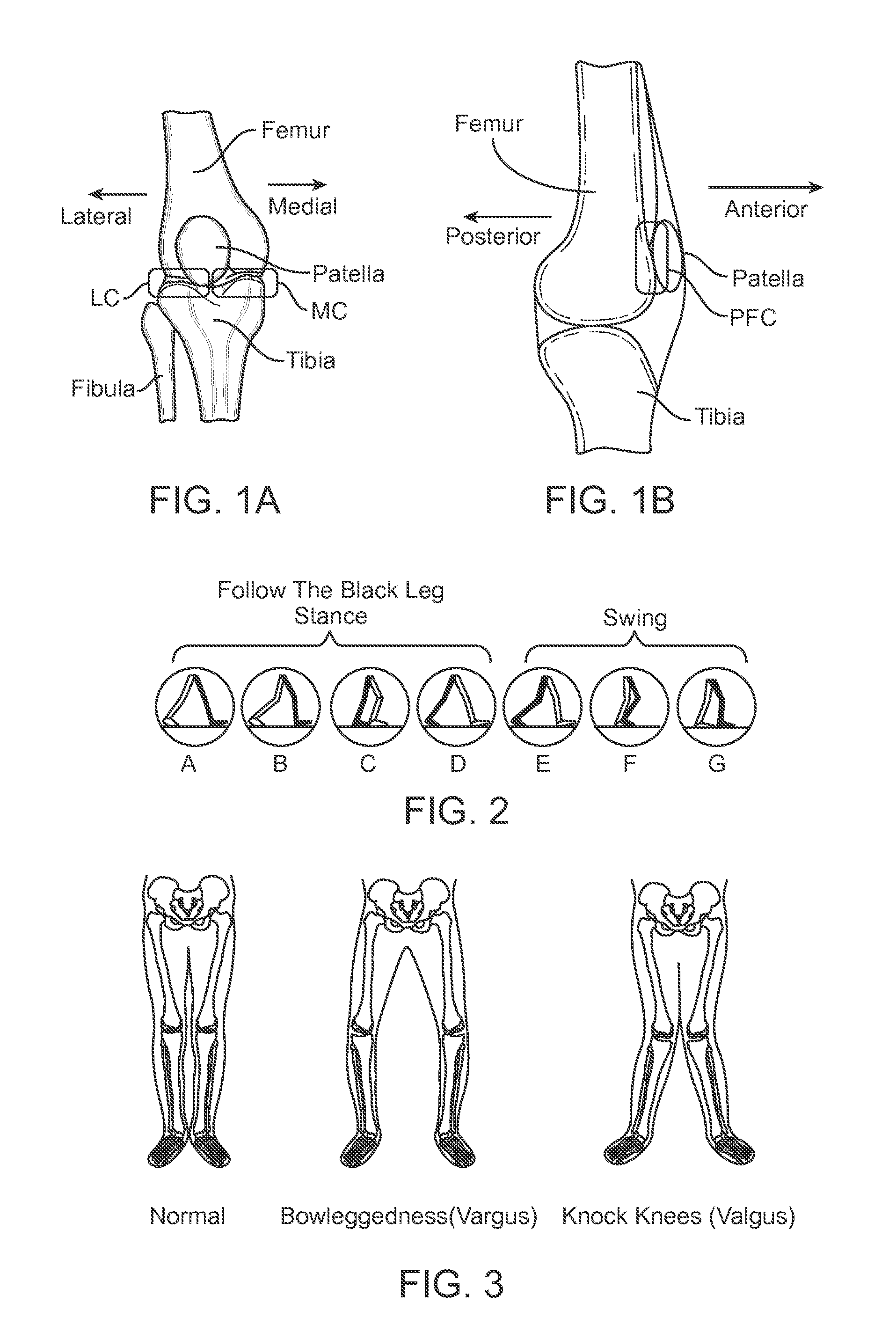 Method and Apparatus for Altering Biomechanics of the Articular Joints