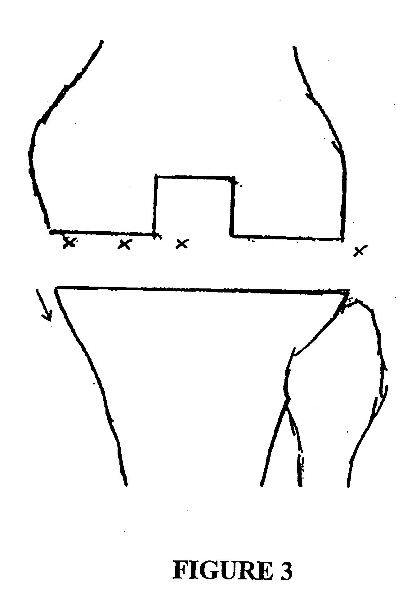 Intra-operative procedure for post-operative pain control