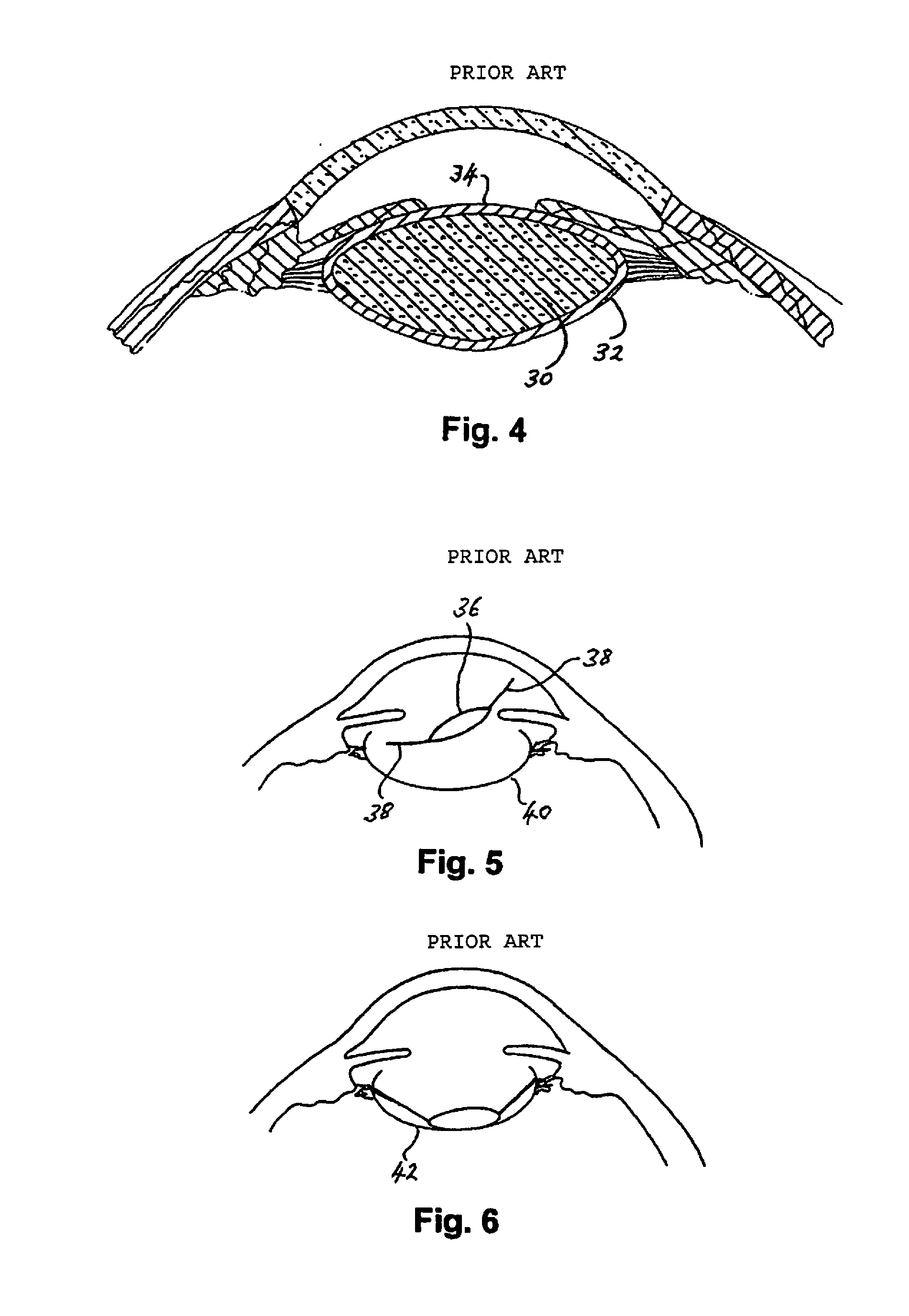 Intraocular implant and method for fixing same into an eye