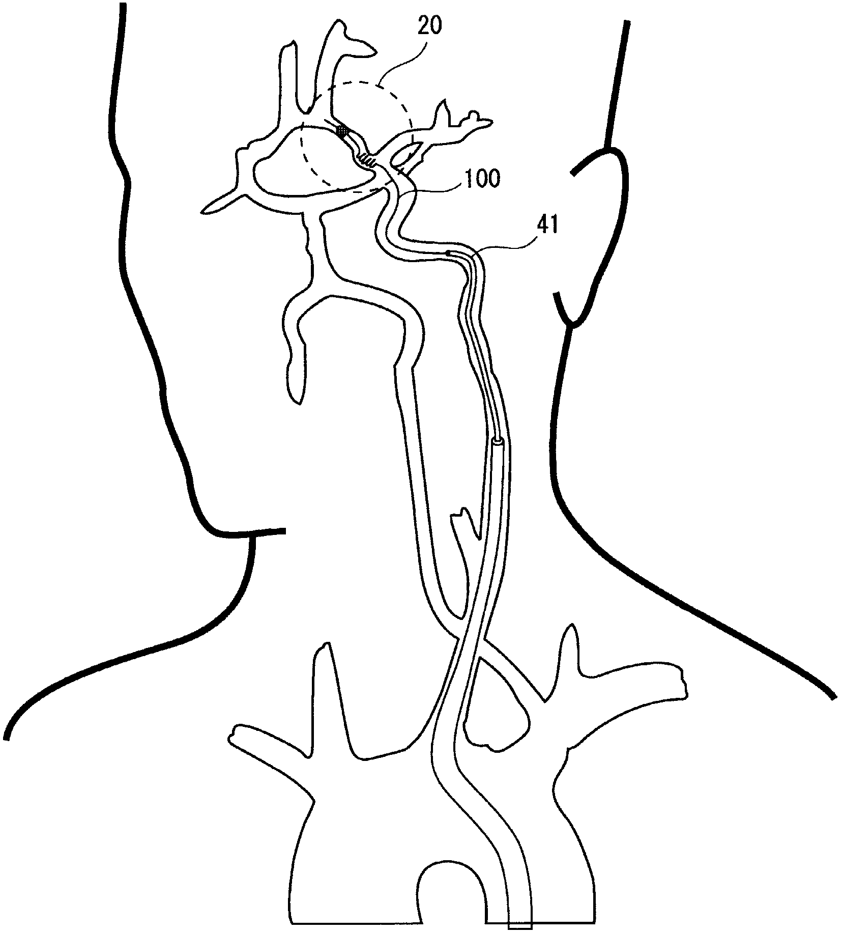 Embolic material excision trapping device