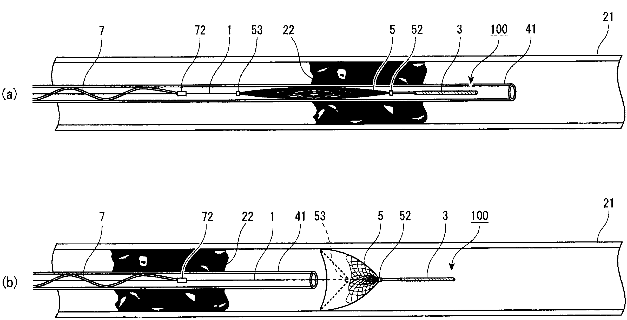 Embolic material excision trapping device