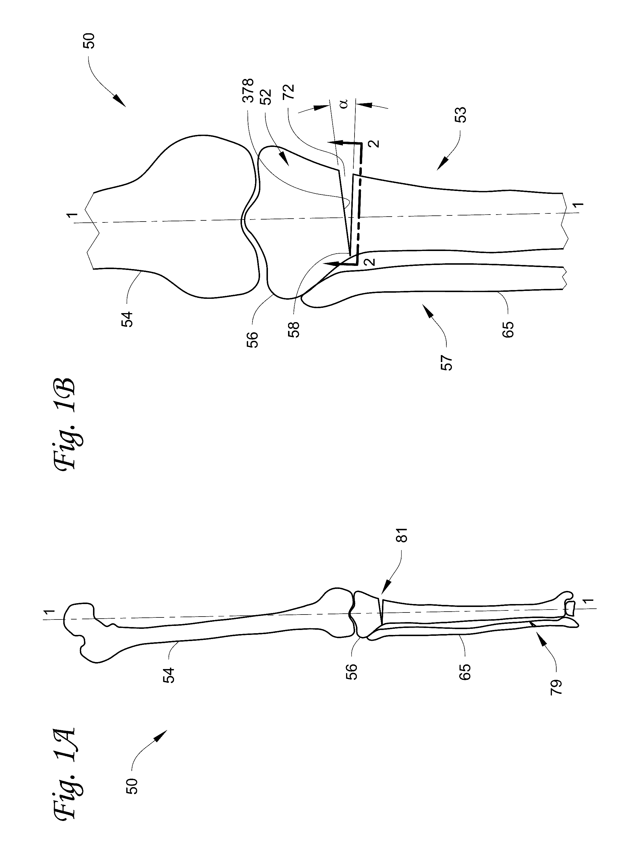 Osteotomy below the tibial tuberosity by multiple drilling