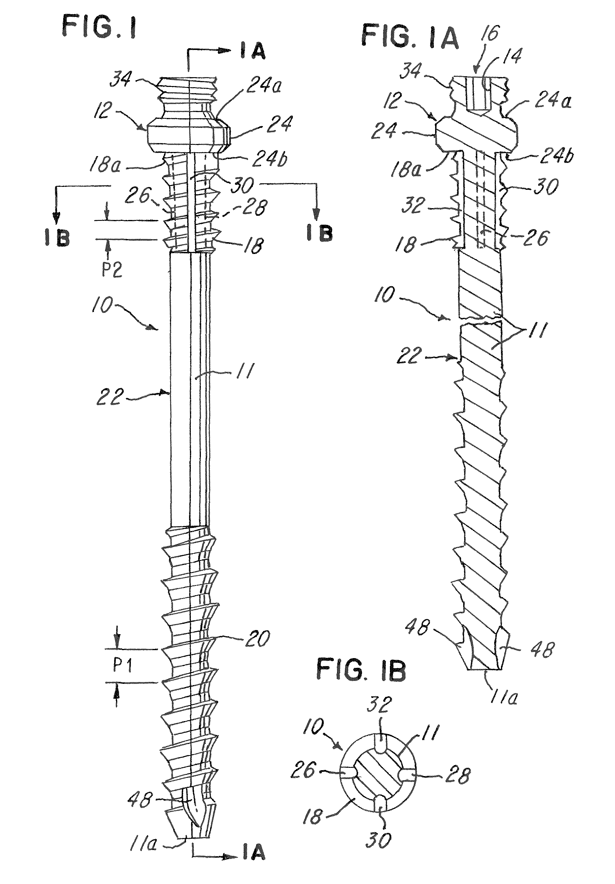 Spinal facet compression screw with variable pitch thread zones and buttress head