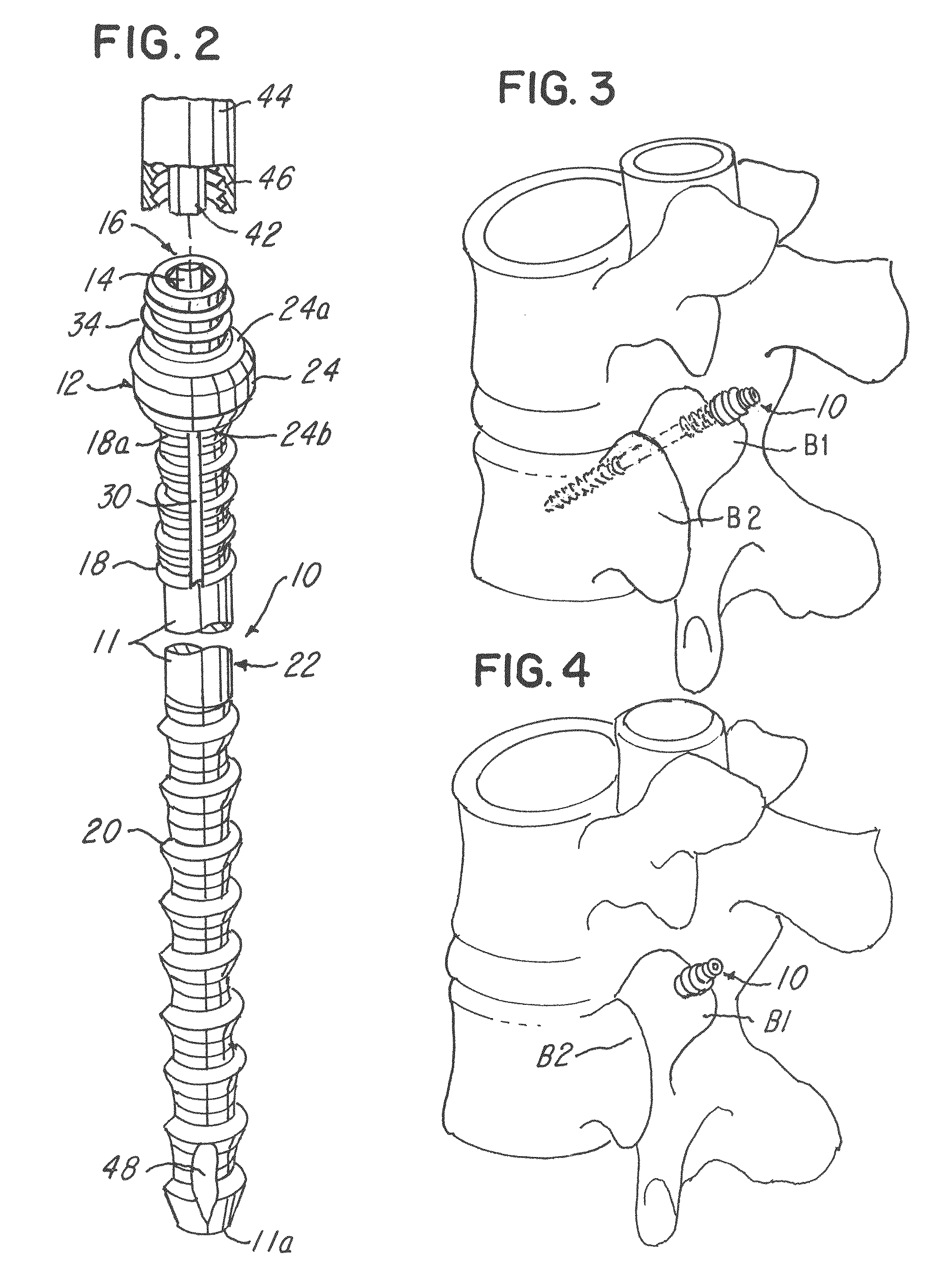 Spinal facet compression screw with variable pitch thread zones and buttress head