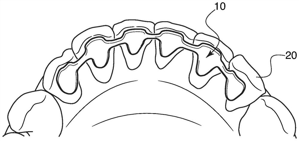 Lingual retainer