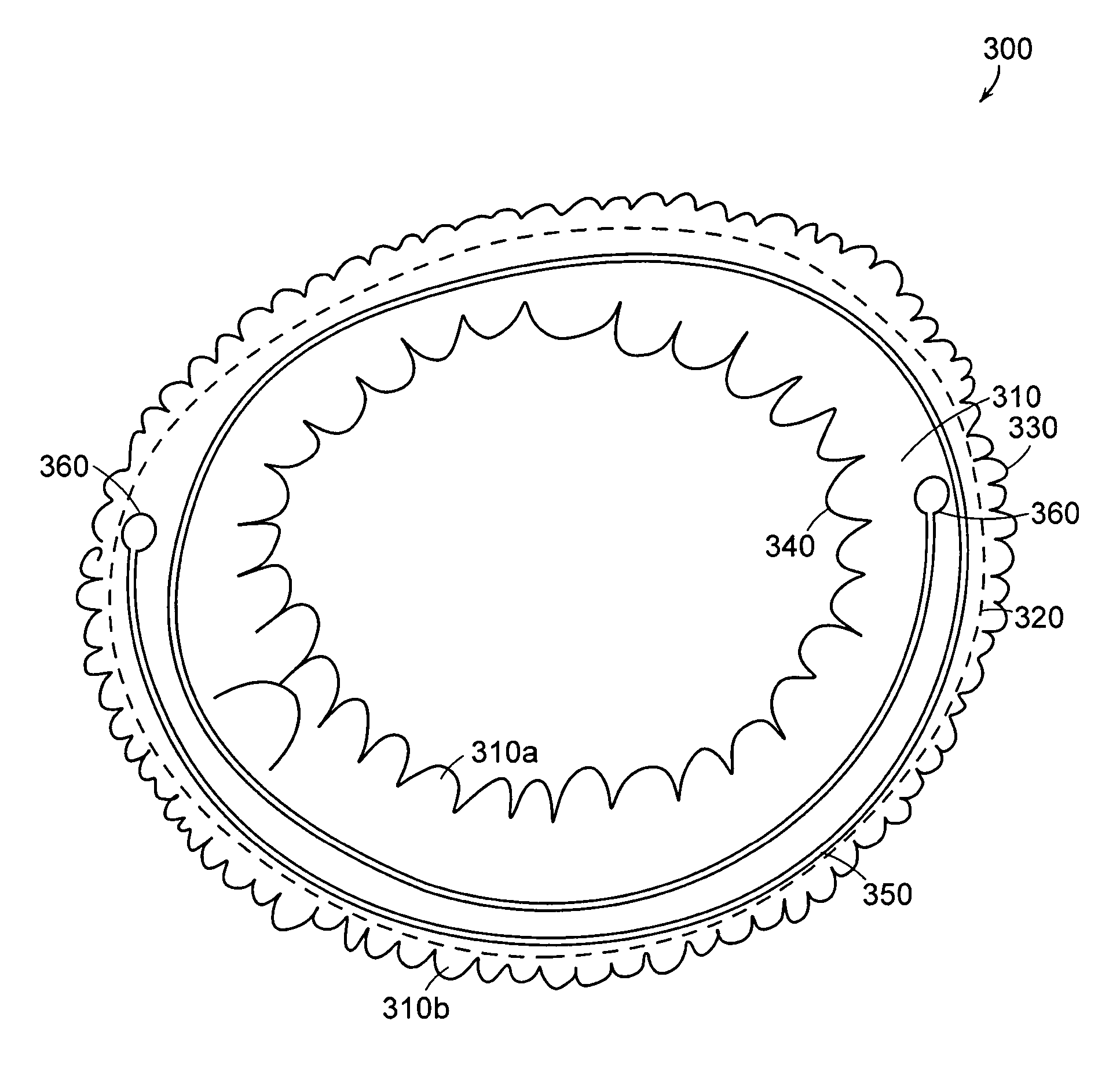 Mitral valve ring for treatment of mitral valve regurgitation