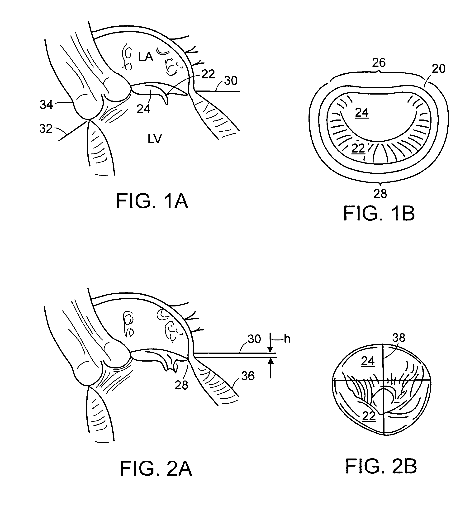 Mitral valve ring for treatment of mitral valve regurgitation