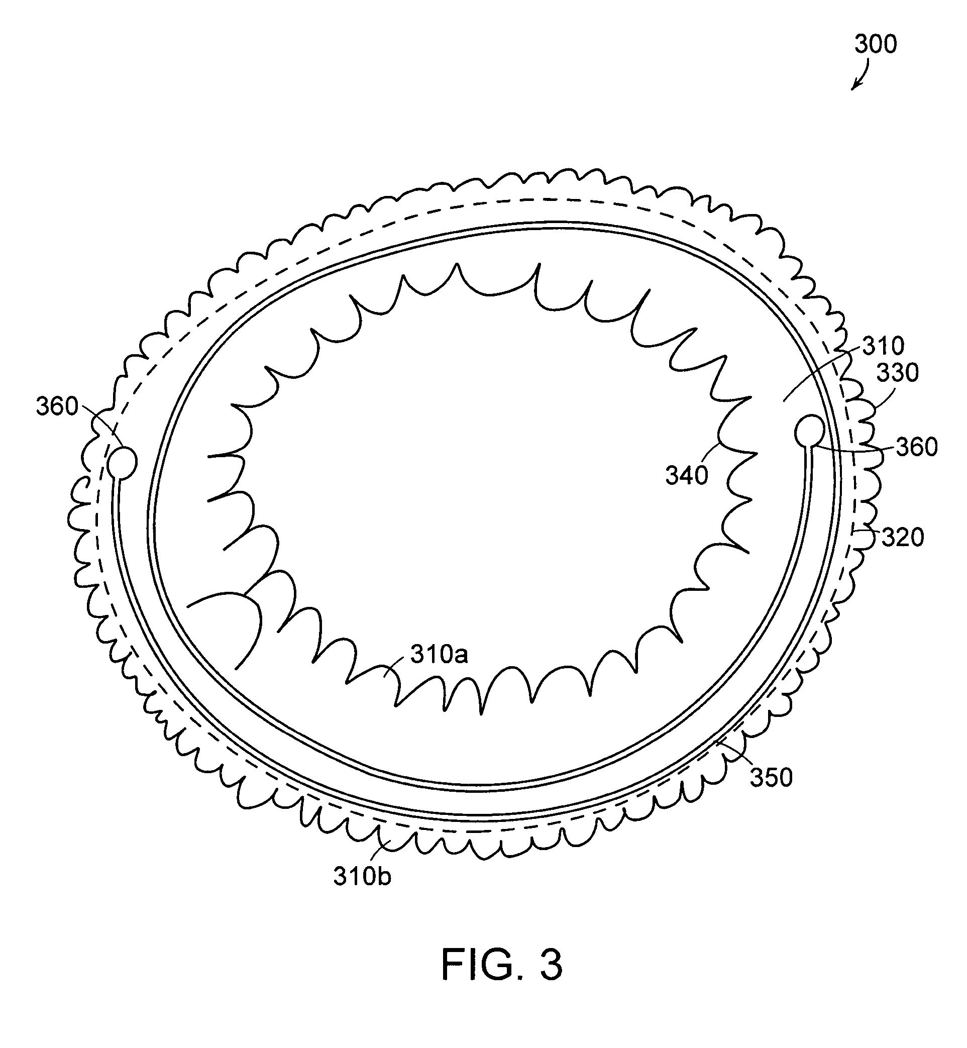 Mitral valve ring for treatment of mitral valve regurgitation