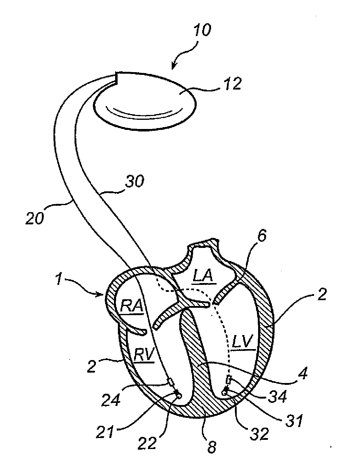 Implantable cardiac stimulator, device and method for monitoring the heart cycle in a human heart