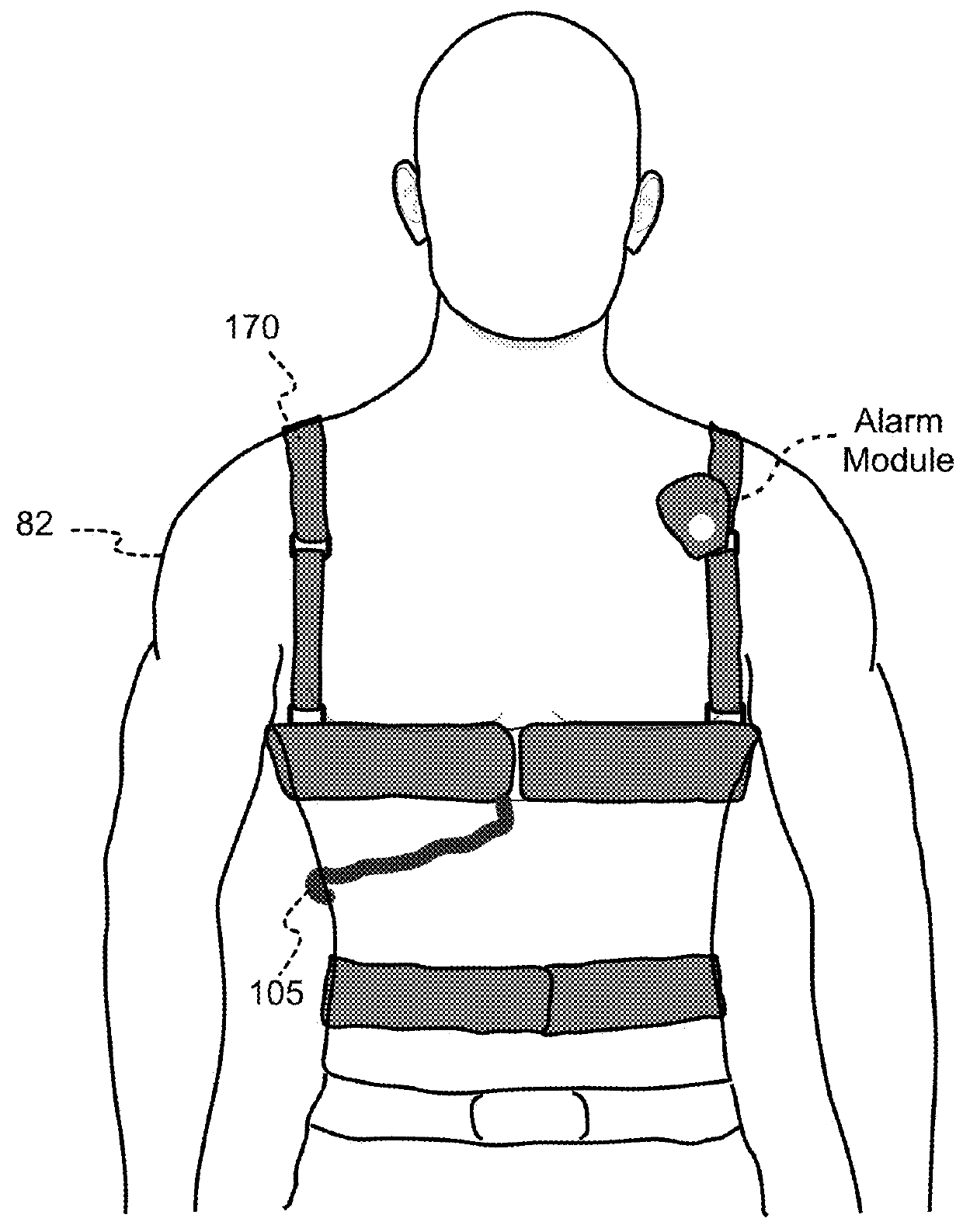 Wcd with separable ECG acquisition features