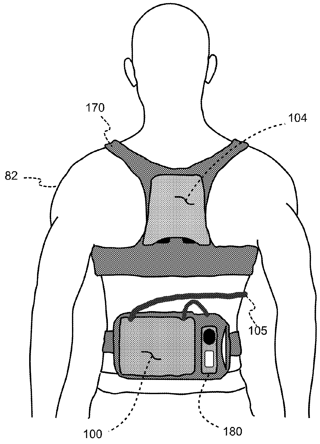 Wcd with separable ECG acquisition features