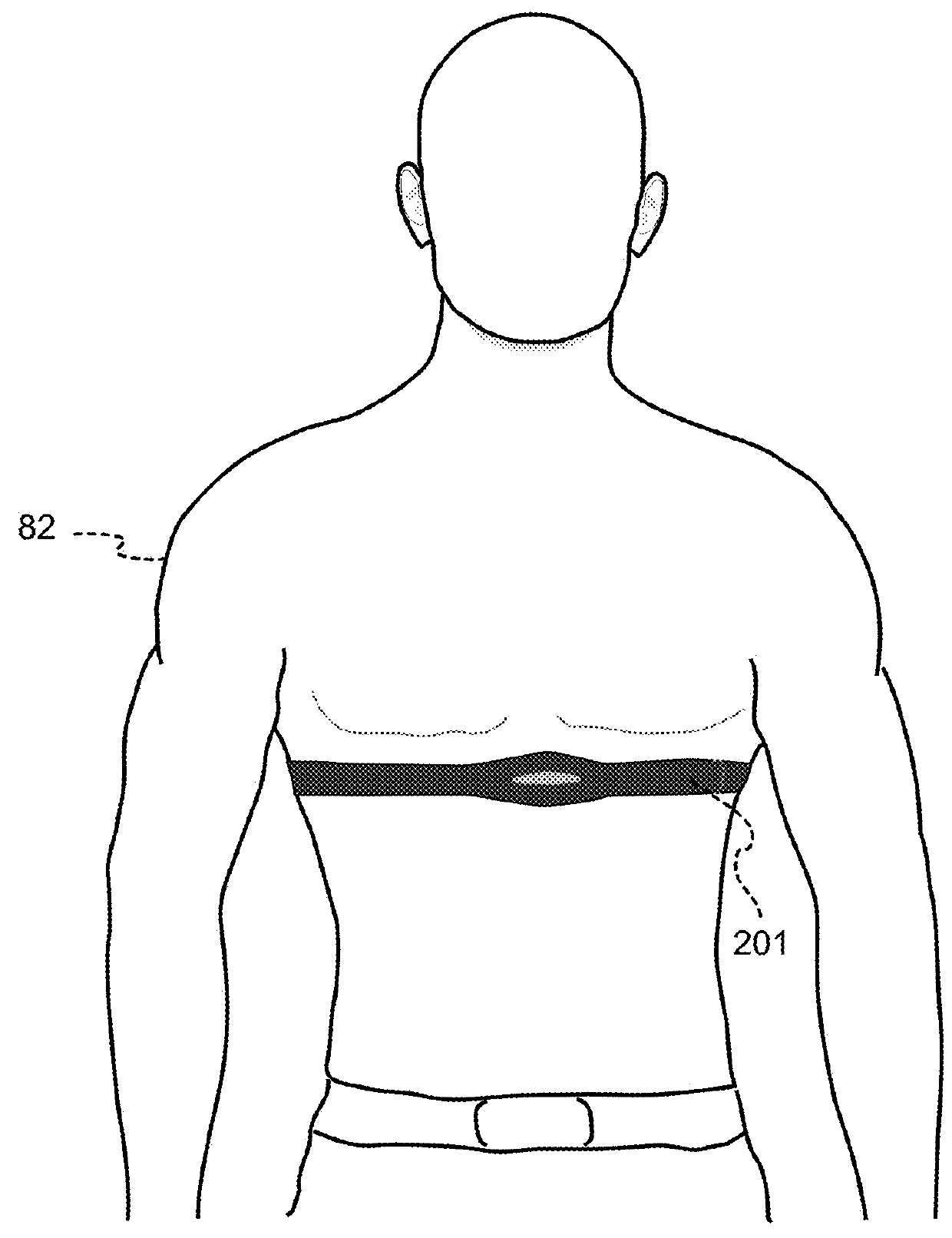 Wcd with separable ECG acquisition features