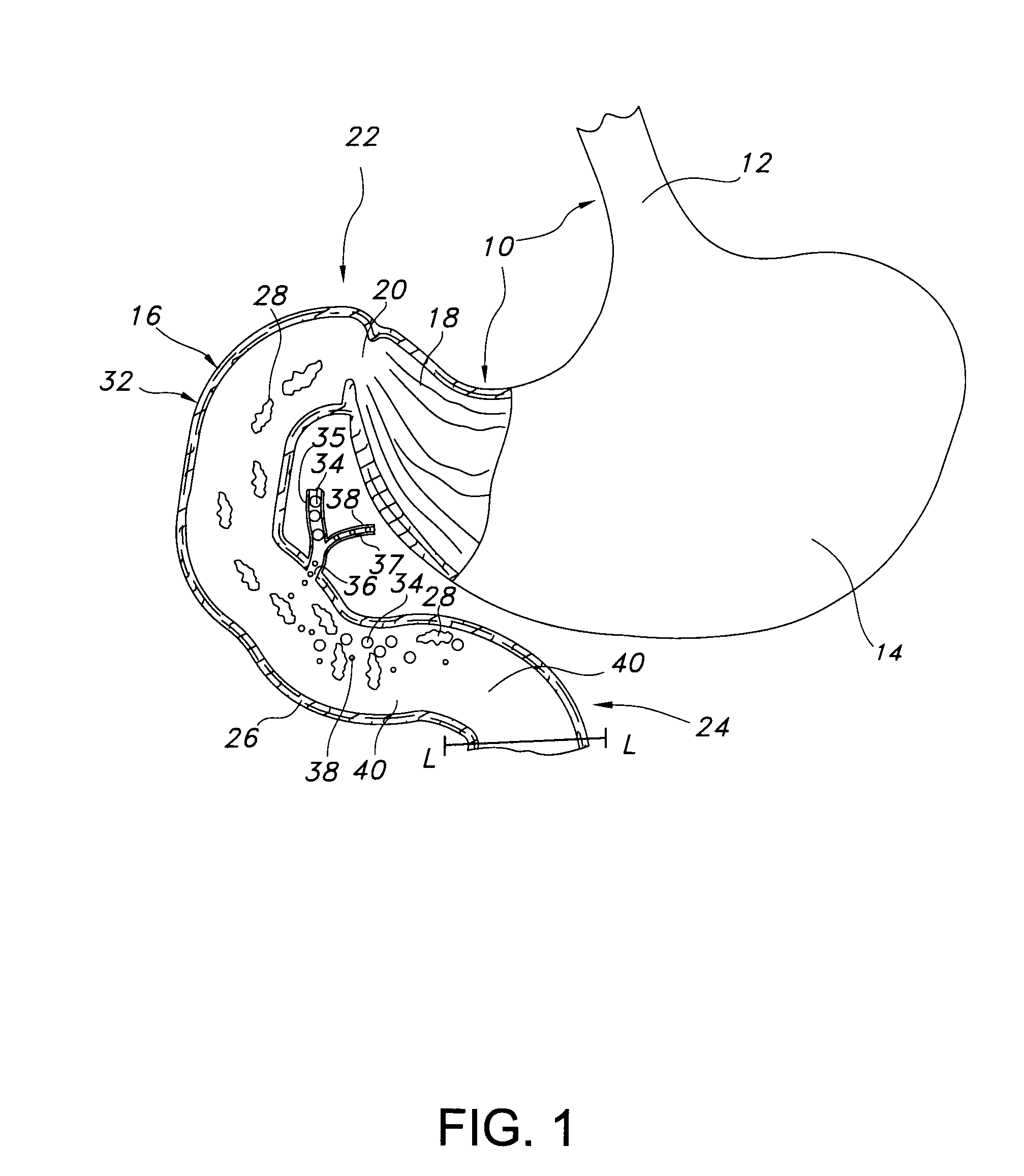 Methods of surgically modifying the duodenum