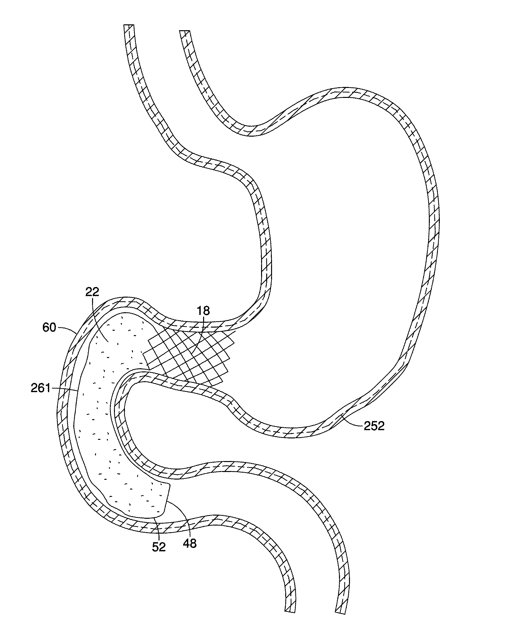 Migration-Resistant Gastrointestinal Barrier