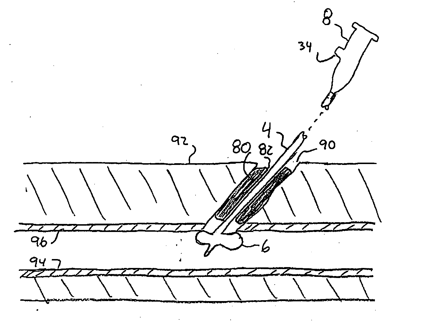 Apparatus and method for temporary hemostasis